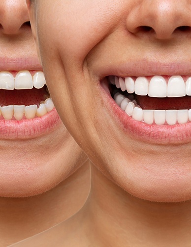 Nose-to-chin before and after shots overlaid on each other showing the improvements from cosmetic dentistry