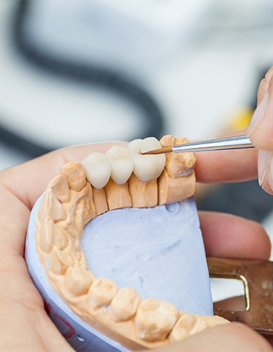 Example of a dental bridge from CityLine Dental Center