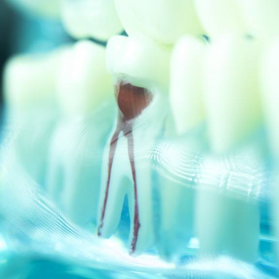 Animated tooth throughout the root canal treatment process