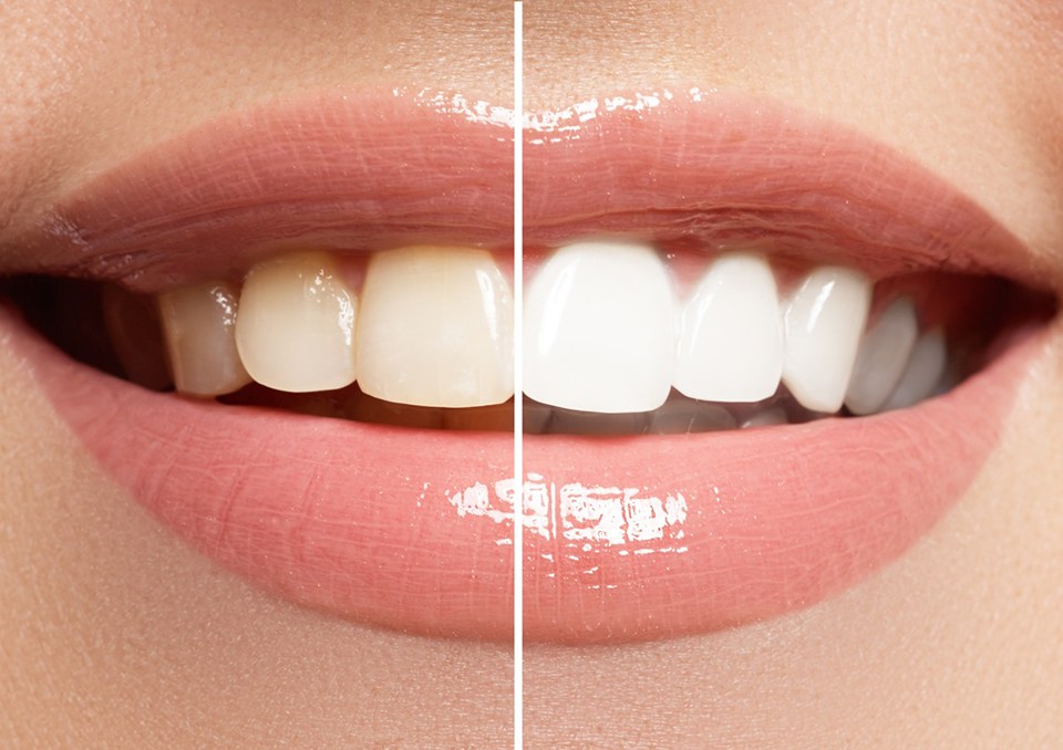 Woman’s teeth before and after teeth whitening in Richardson